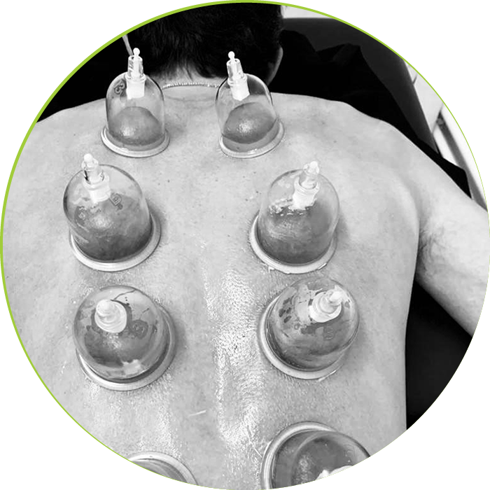 Cupping Cupping