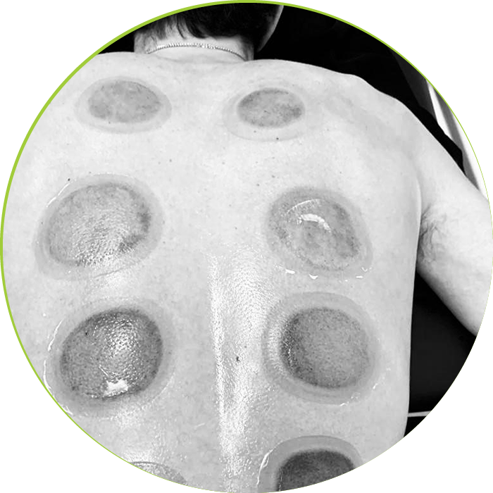 Cupping Cupping