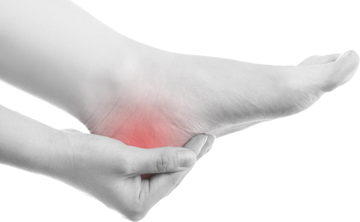 Plantar Fasciitis 1