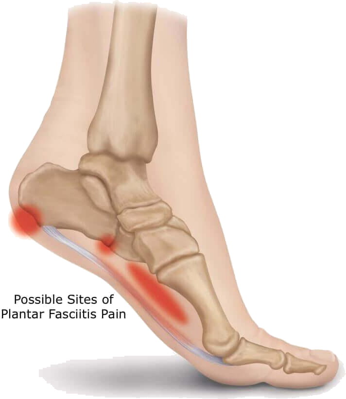 Plantar Fasciitis 2 Plantar Fasciitis